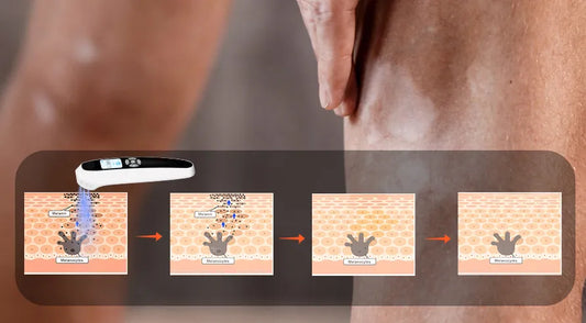 Blue Light and Melanoma Cell Inhibition